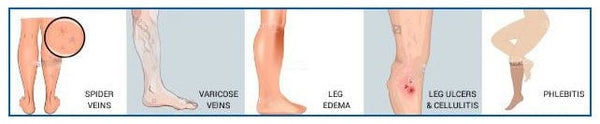 20-30 mmHg Women Men Medical Calf Compression Sleeve Varicose Veins Socks Leg Support DVT Anti-fatigue Flight Travel Open Toe - Vimost Shop