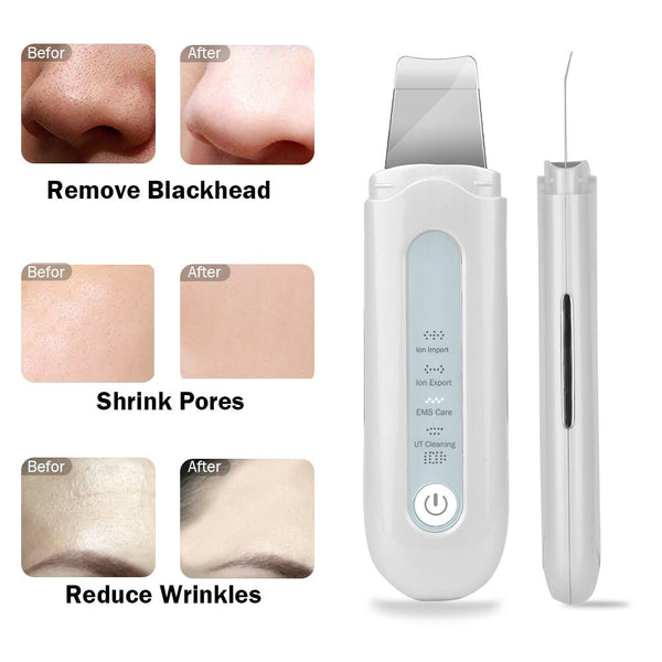 Blackhead Removal Skin Scrubber Ion Vibration Acne Exfoliating Peeling Spatula Ultrasonic Deep Face Cleaning Pore Cleaner Tool - Vimost Shop