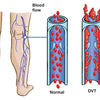 Calf Compression Socks Sleeve 30-40 mmHg Hosiery Support Hose Medical Varicose Veins Women Men Treatment Surgery,Edema,Nursing - Vimost Shop